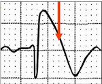 brugada