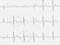 brugada0