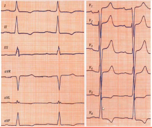 ekg glzh