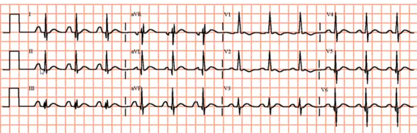 ekg gpp