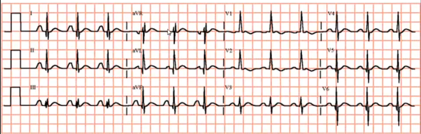ekg gpzh3