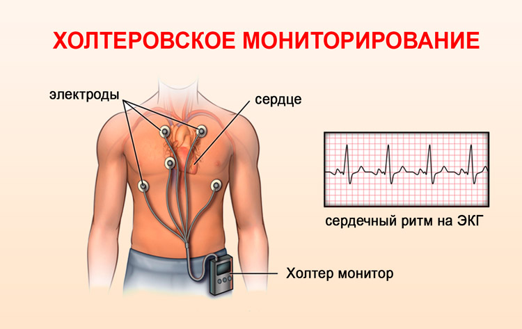 holterovskoe monitorirovanie 2