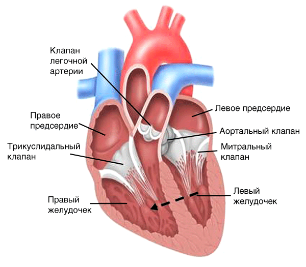 Дефект межжелудочковой перегородки