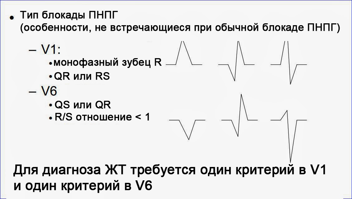 Признак Бругада 3