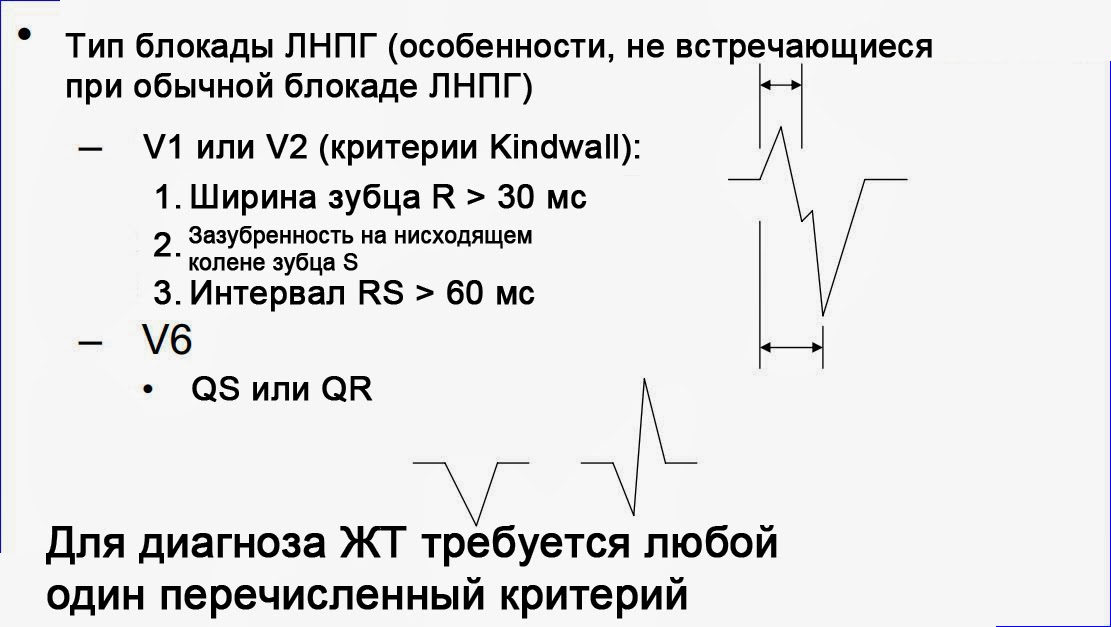 Признак Бругада 4