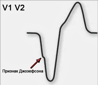 Признак Джозефсона