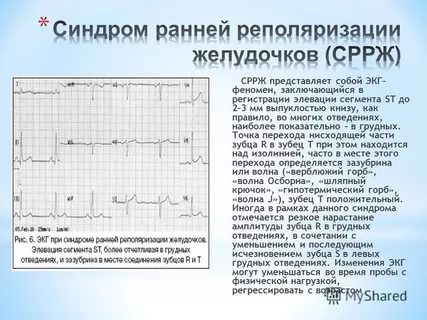 СРРЖ