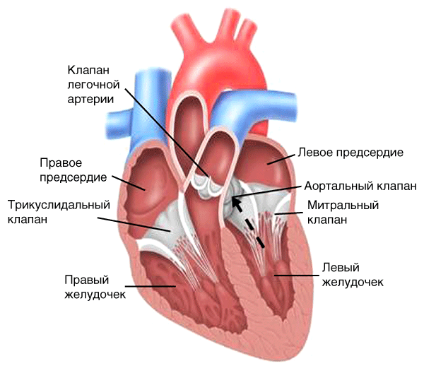 Стеноз устья аорты