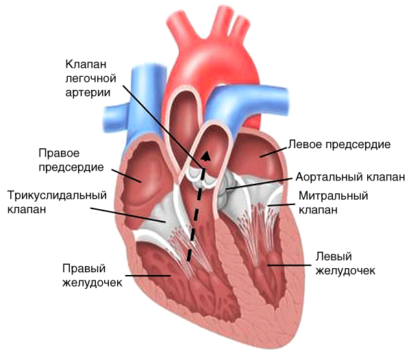 Стеноз устья легочной артерии